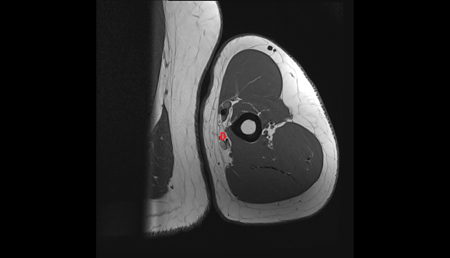 Basilic Vein axial cross sectional anatomy 3T MRI AI enhanced radiology image -img-00000-00000