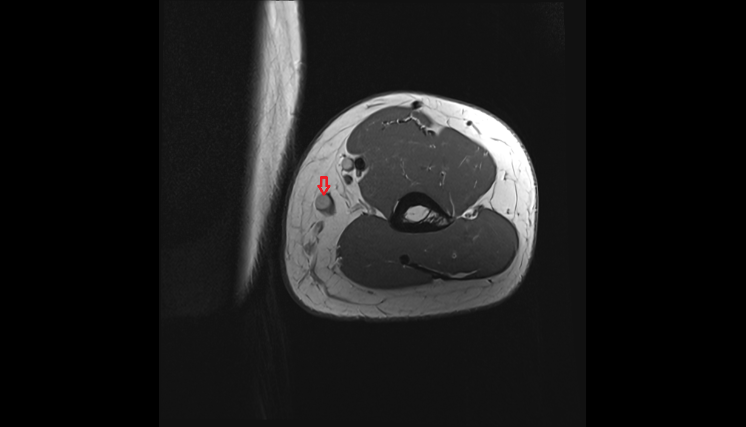 Basilic Vein axial cross sectional anatomy 3T MRI AI enhanced radiology image -img-00000-00000_00001