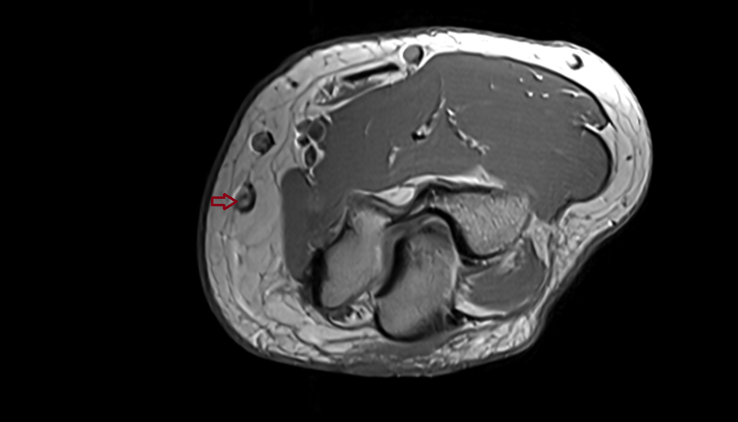 Basilic vein of forearm axial cross sectional anatomy 3T MRI AI enhanced radiology image -img-00000-00000