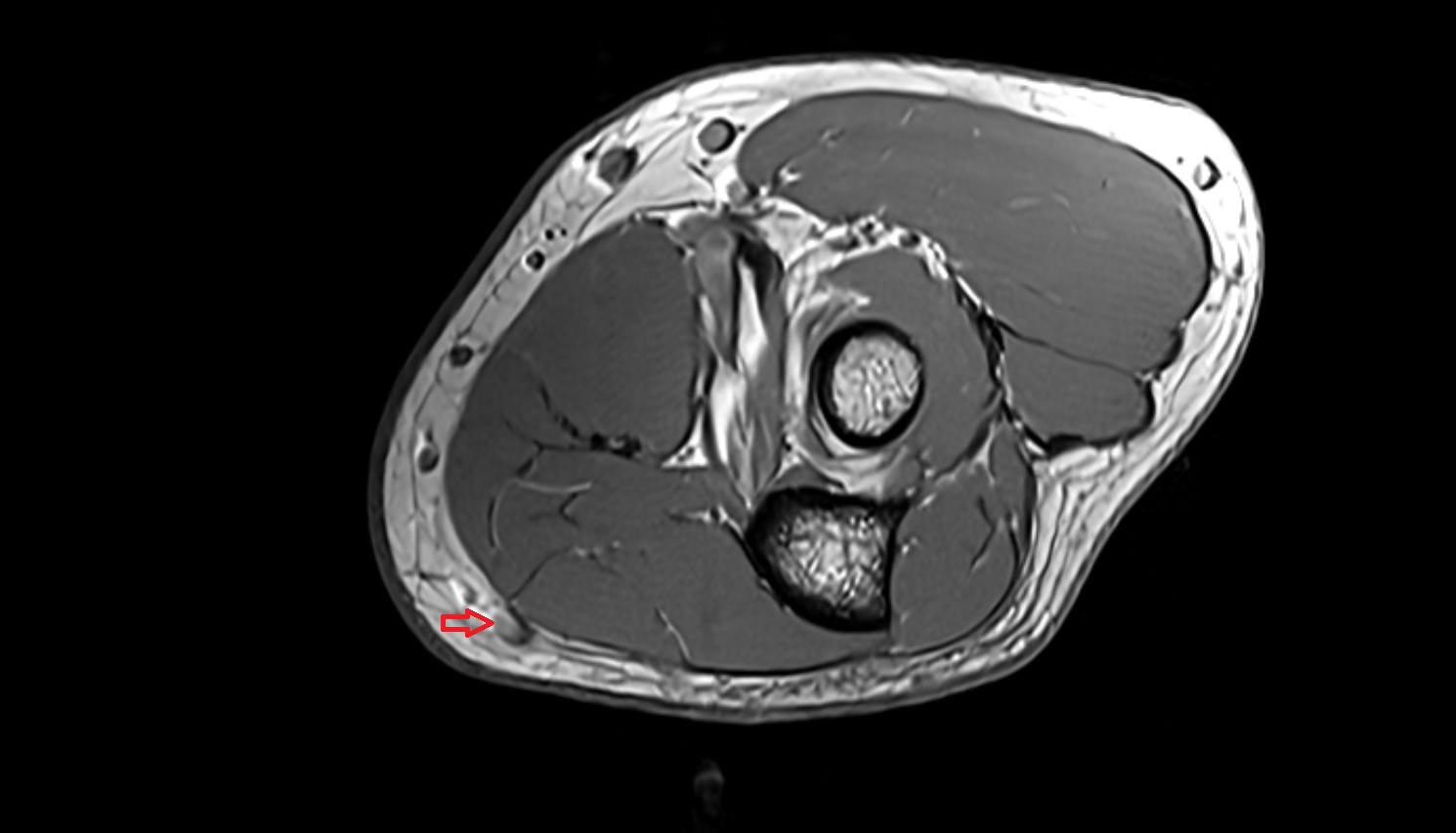 Basilic vein of forearm axial cross sectional anatomy 3T MRI AI enhanced radiology image -img-00000-00000_00001
