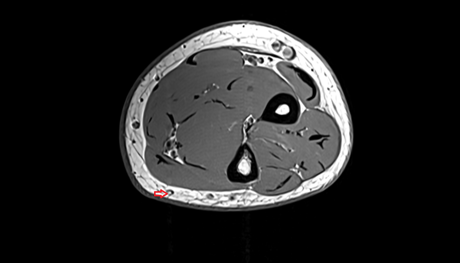 Basilic vein of forearm axial cross sectional anatomy 3T MRI AI enhanced radiology image -img-00000-00000_00002