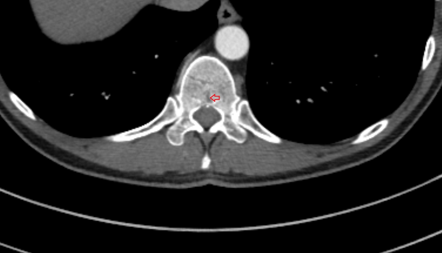 Basivertebral veins  CT  axial  image -img-00000-00000