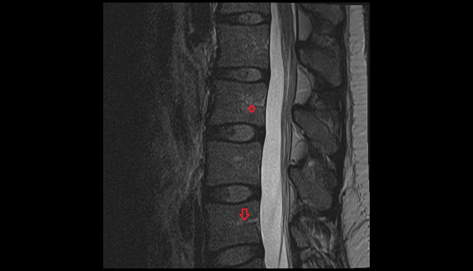 Basivertebral veins SAGITTAL MRI IMAGE