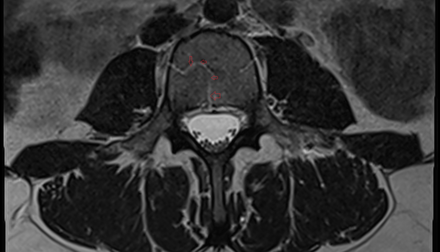 Basivertebral veins  mri  axial anatomy  image-img-00000-00000