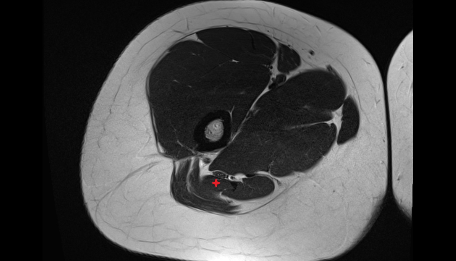Biceps Femoris Muscle (Long Head)  MRI axial anatomy image-img-00000-00000