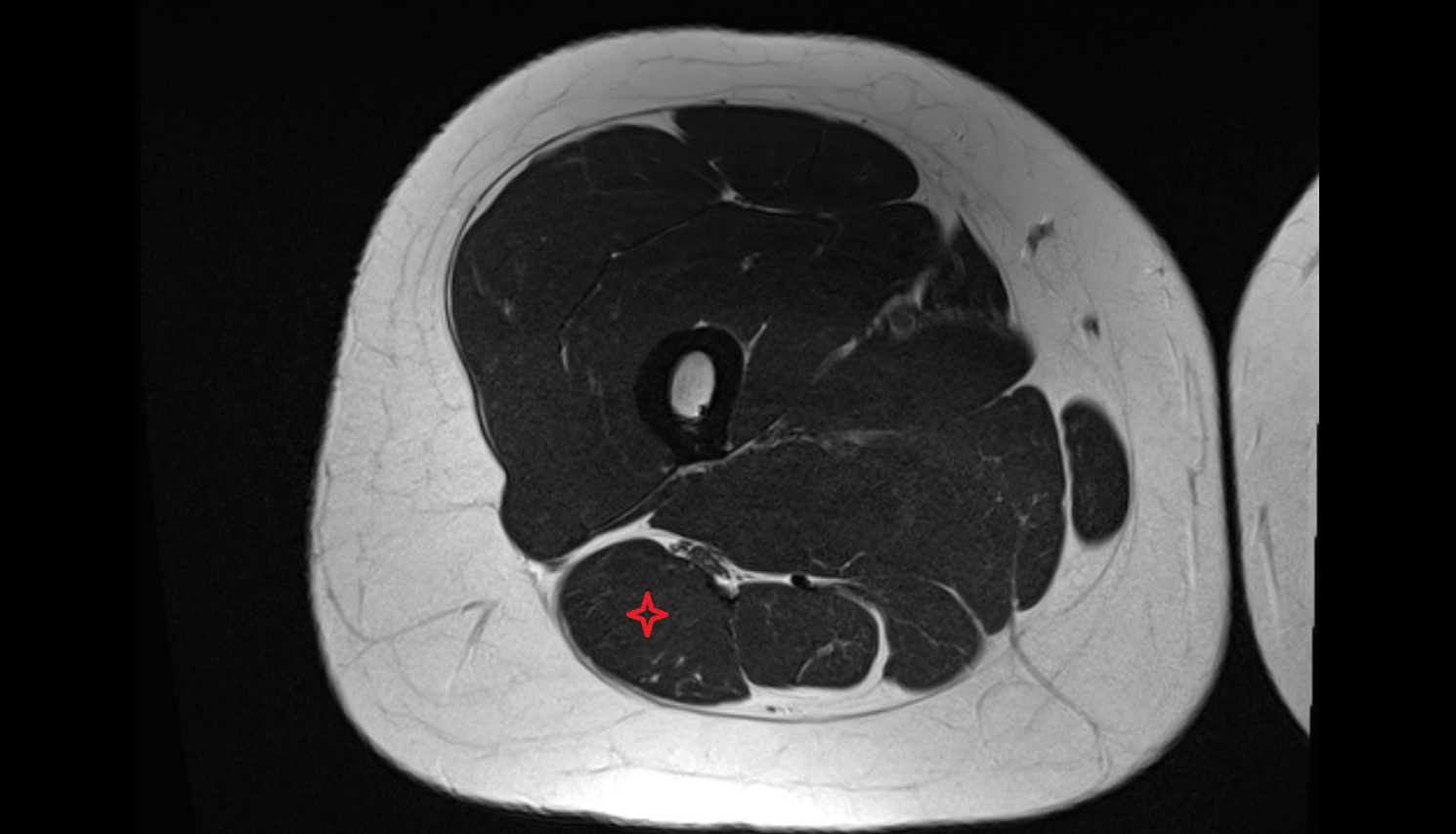 Biceps Femoris Muscle (Long Head)  MRI axial anatomy image-img-00000-00000_00001