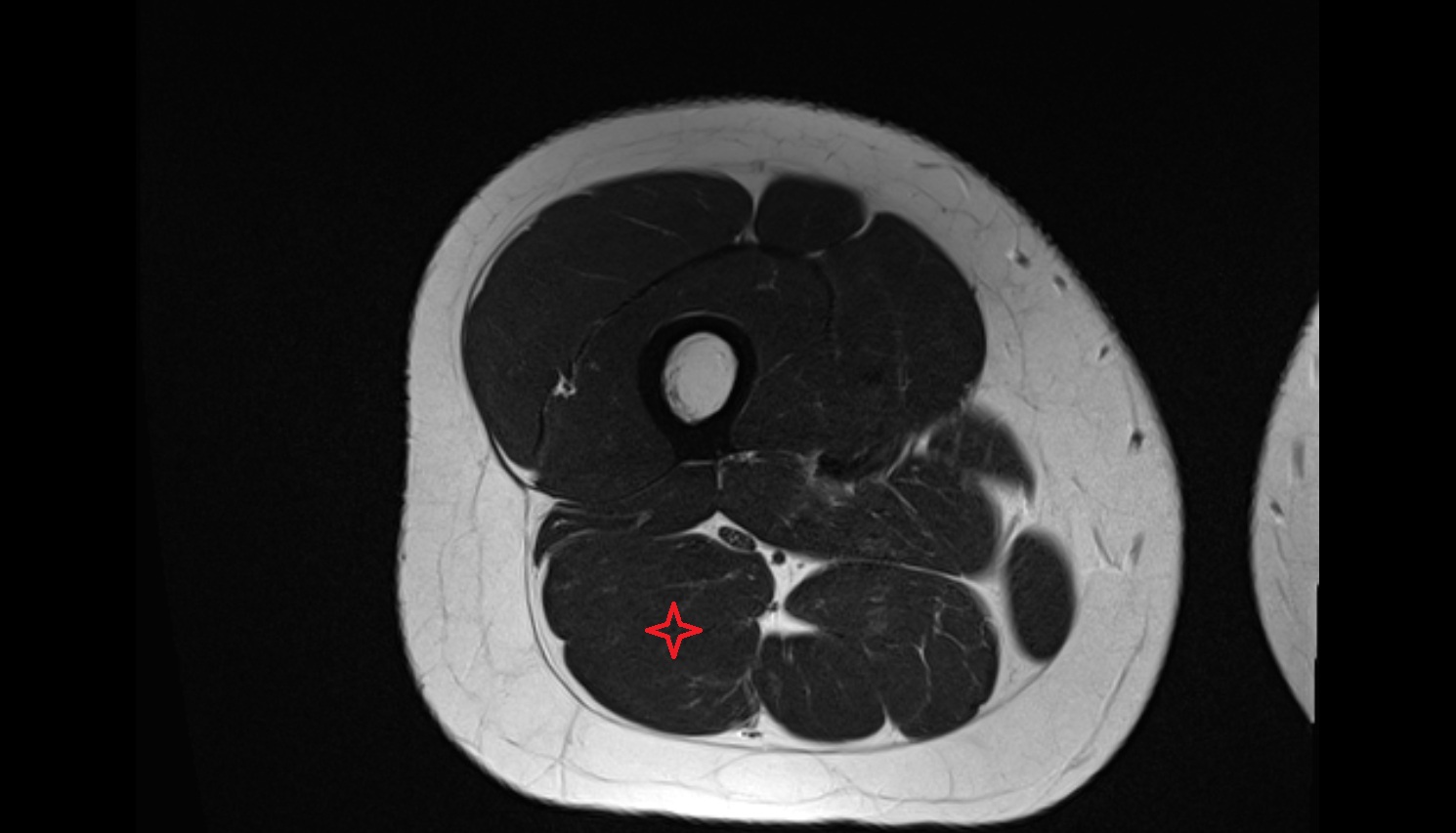Biceps Femoris Muscle (Long Head)  MRI axial anatomy image-img-00000-00000_00002
