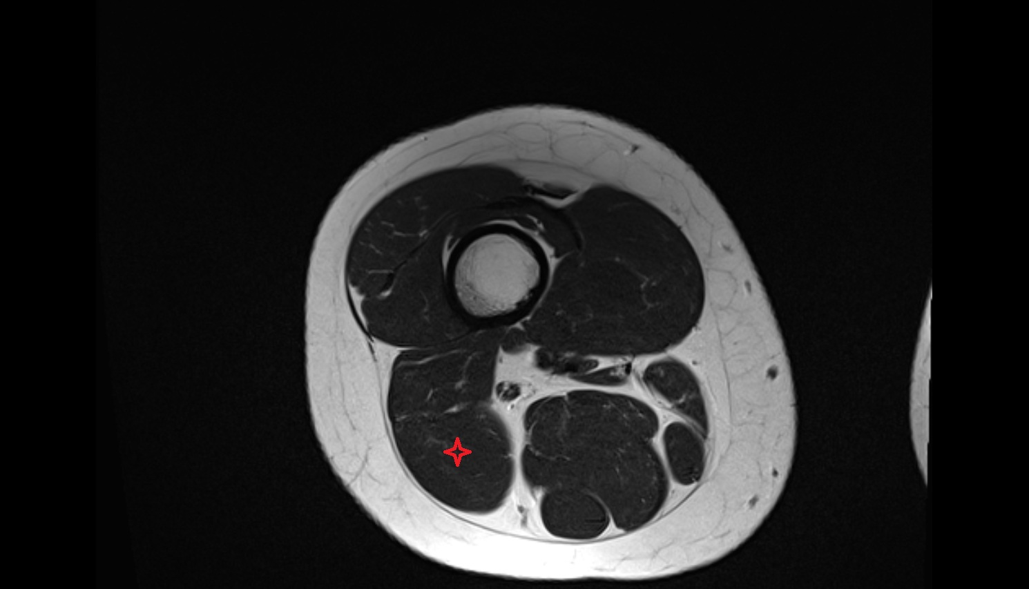 Biceps Femoris Muscle (Long Head)  MRI axial anatomy image-img-00000-00000_00003