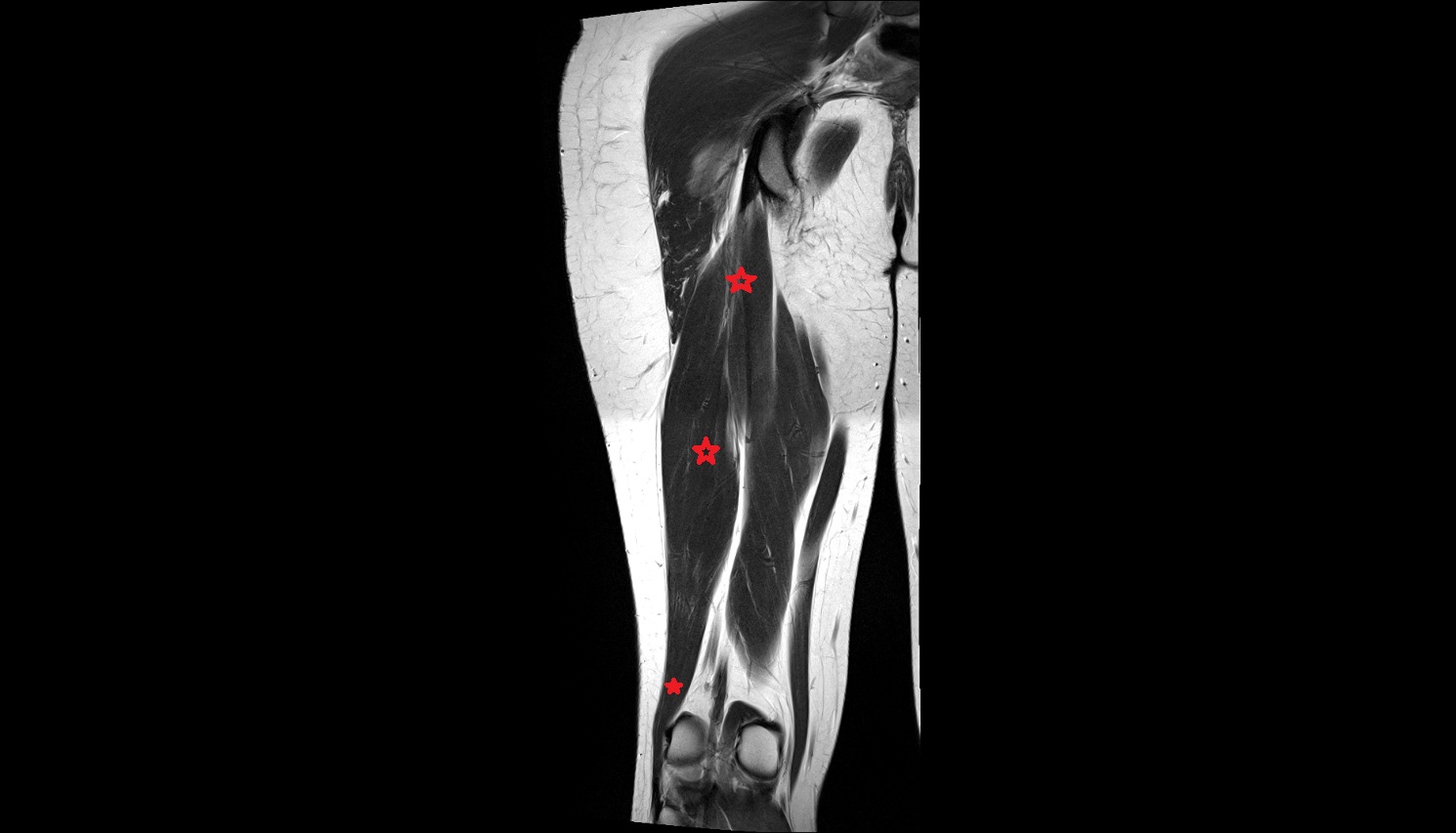 Biceps Femoris Muscle (Long Head)  MRI coronal anatomy image-img-00000-00000_00004