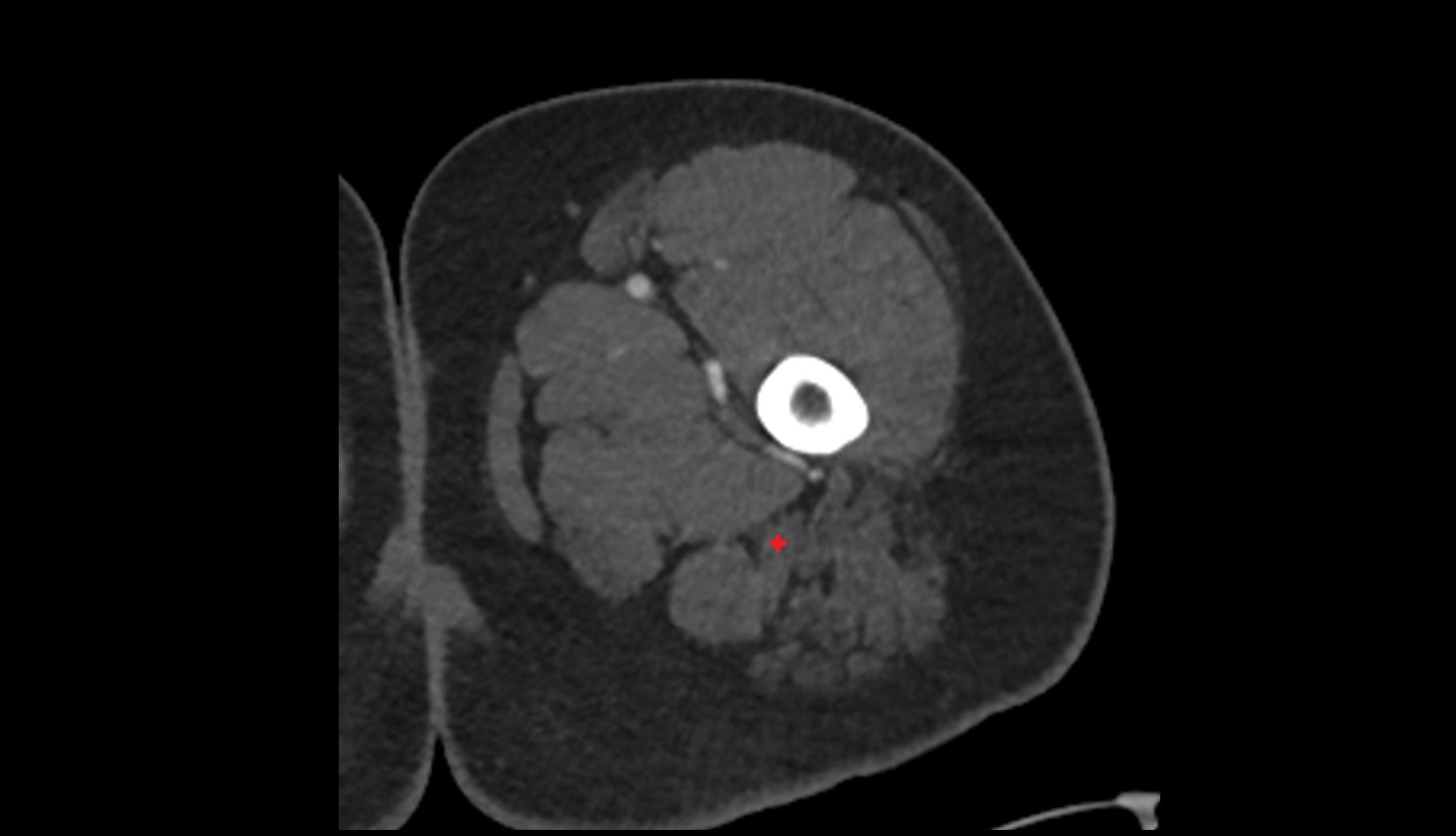 Biceps Femoris Muscle (Long Head) ct axial image 0