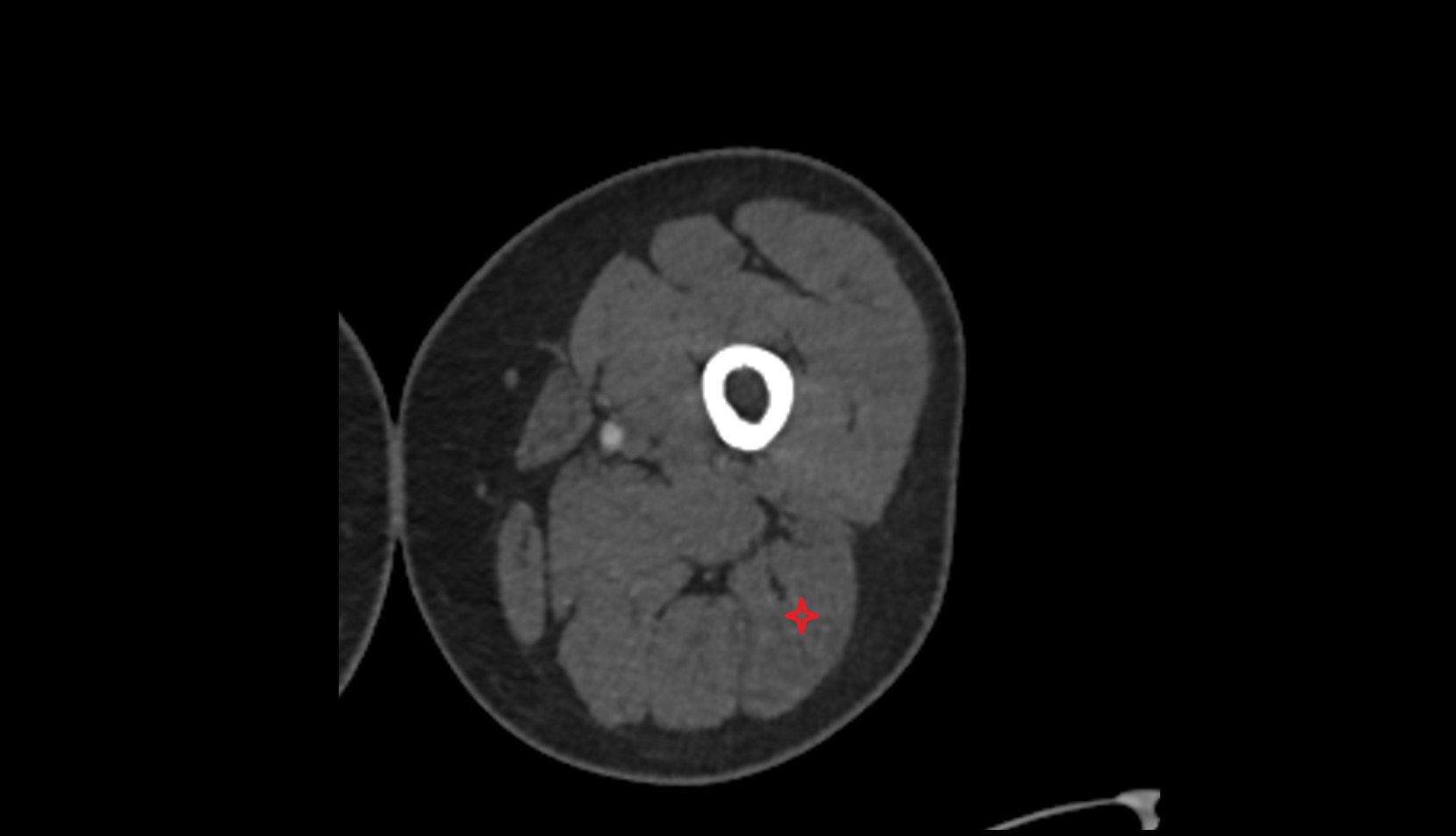 Biceps Femoris Muscle (Long Head) ct axial image 1