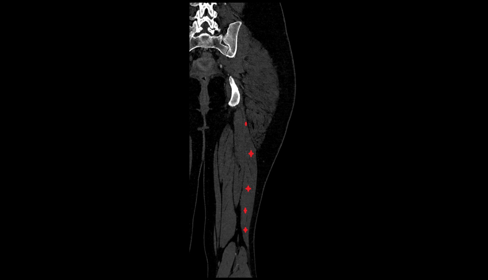Biceps Femoris Muscle (Long Head) ct coronal image