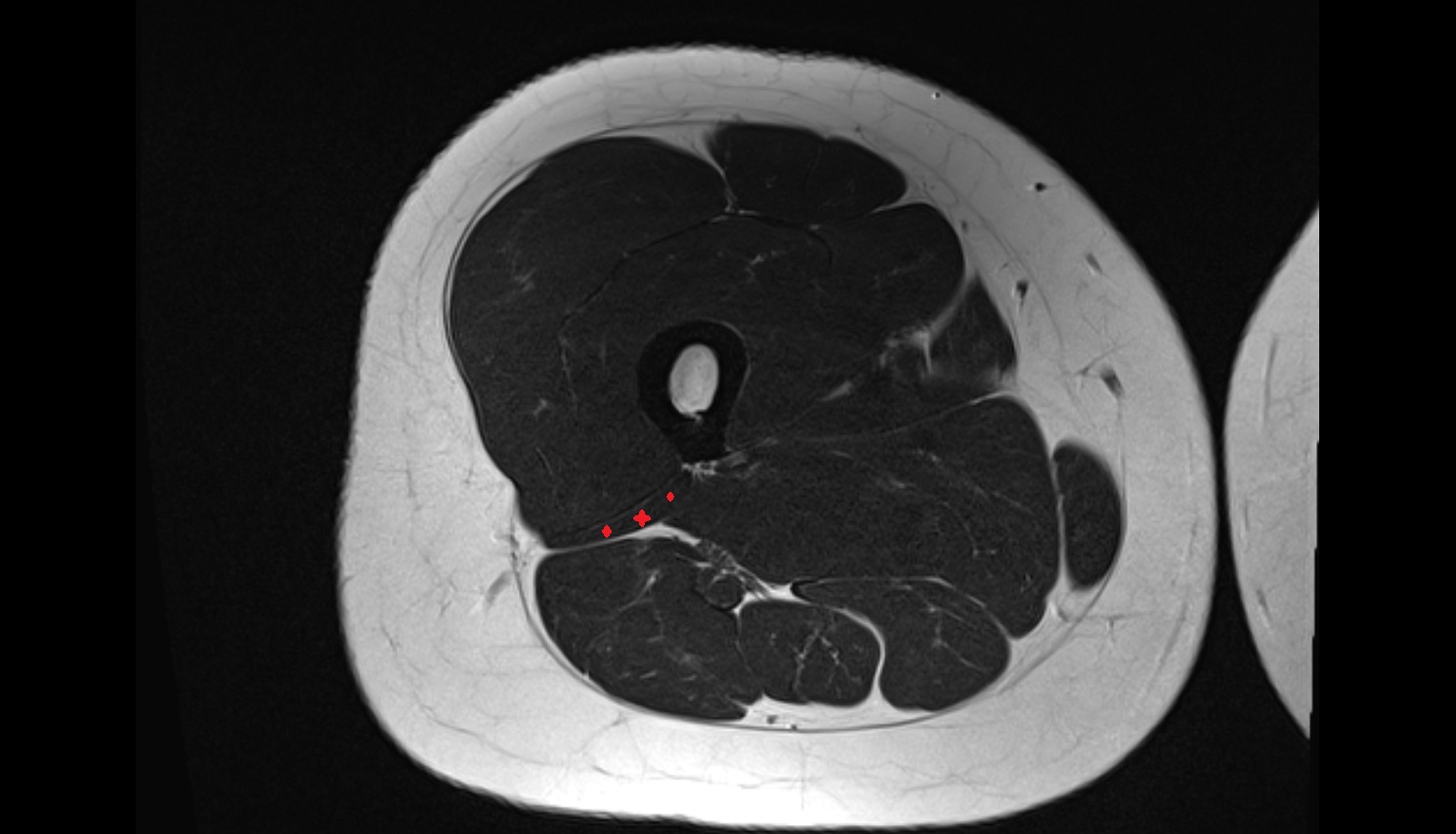 Biceps Femoris Muscle, Short Head   MRI axial anatomy image-img-00000-00000