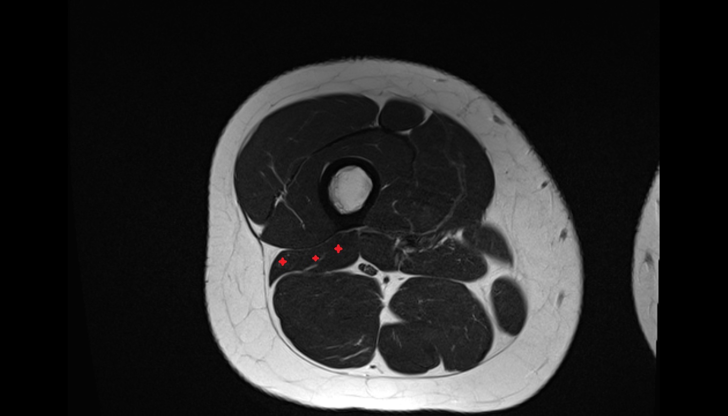Biceps Femoris Muscle, Short Head   MRI axial  anatomy image-img-00000-00000_00001