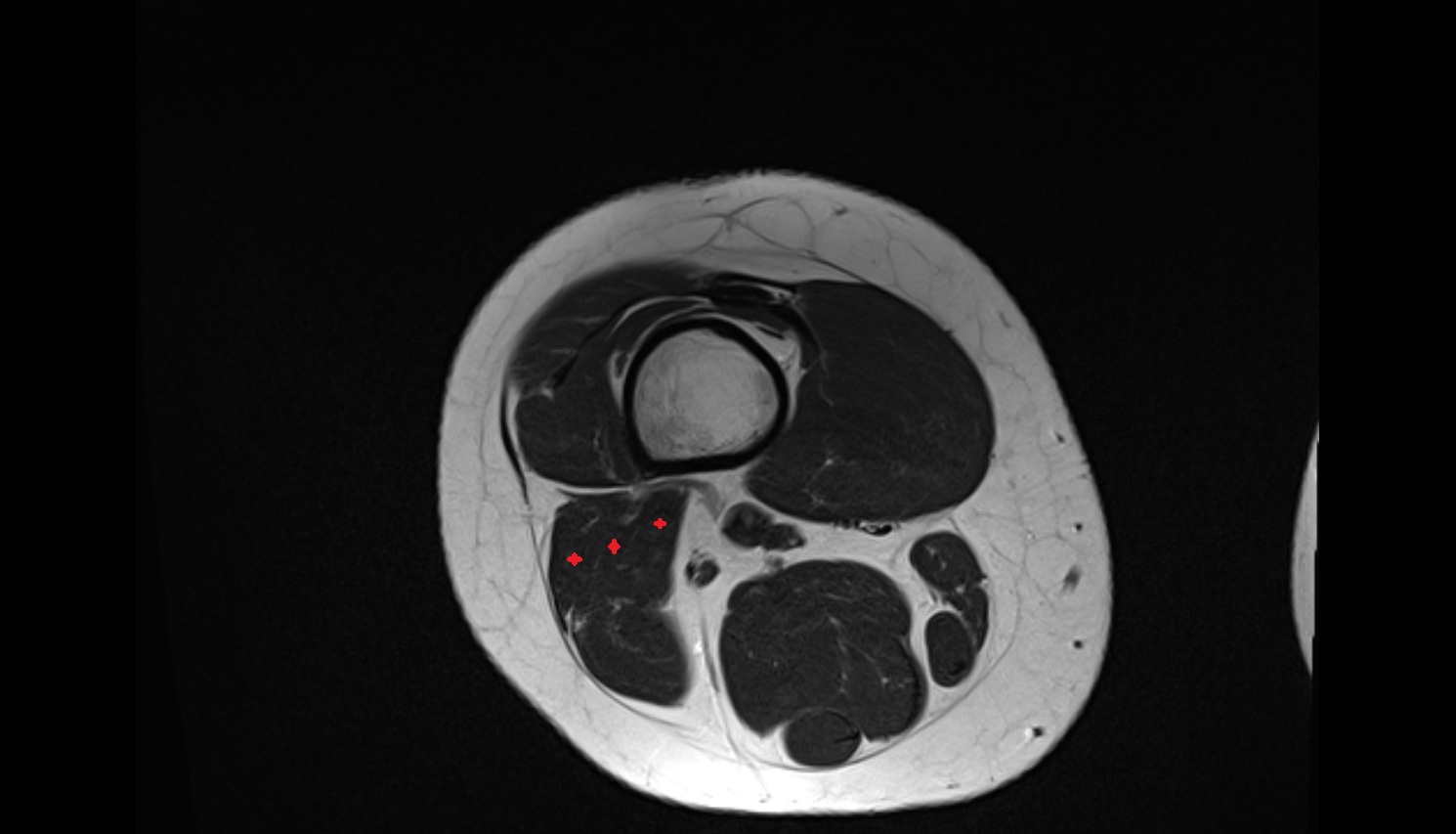 Biceps Femoris Muscle, Short Head   MRI axial  anatomy image-img-00000-00000_00002