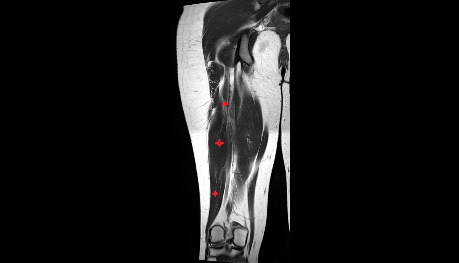 Biceps Femoris Muscle (Short Head)  MRI coronal anatomy image-img-00000-00000