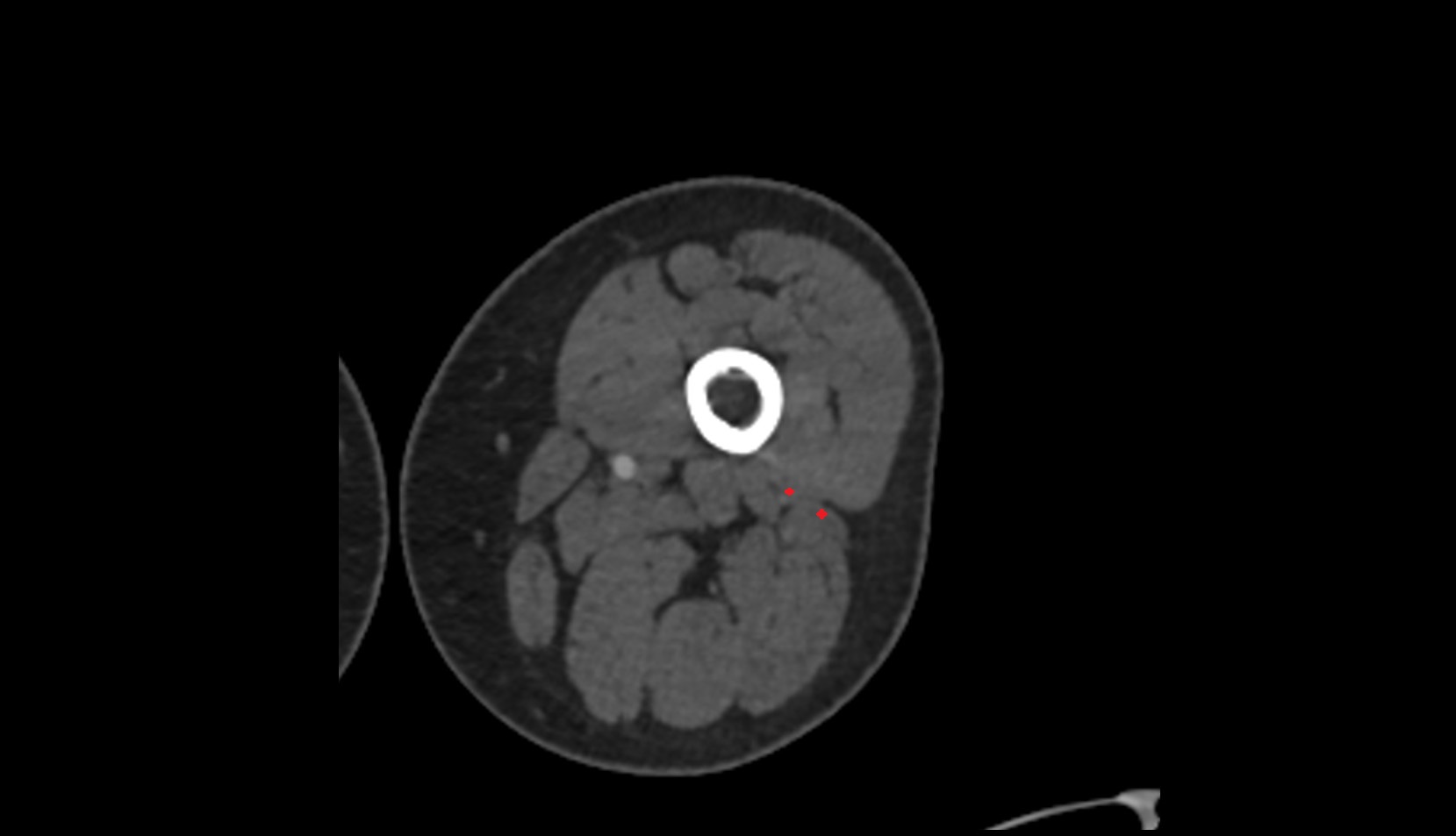 Biceps Femoris Muscle (Short Head) ct axial image 1