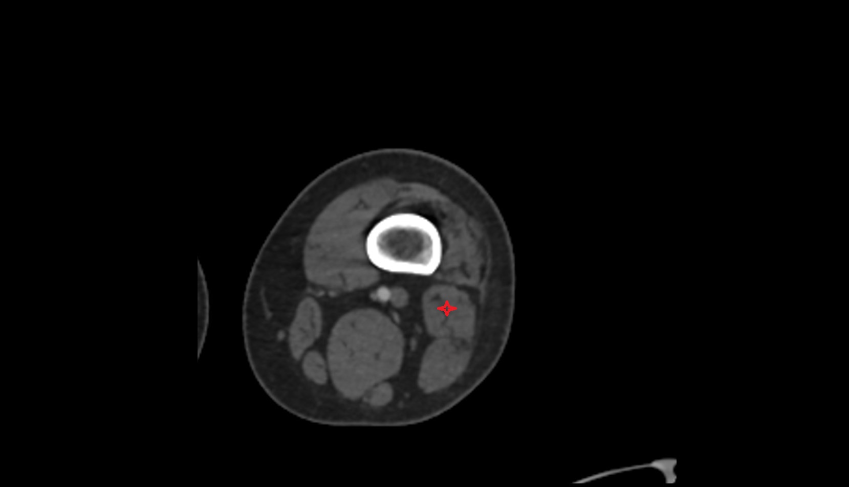 Biceps Femoris Muscle (Short Head) ct axial image 2