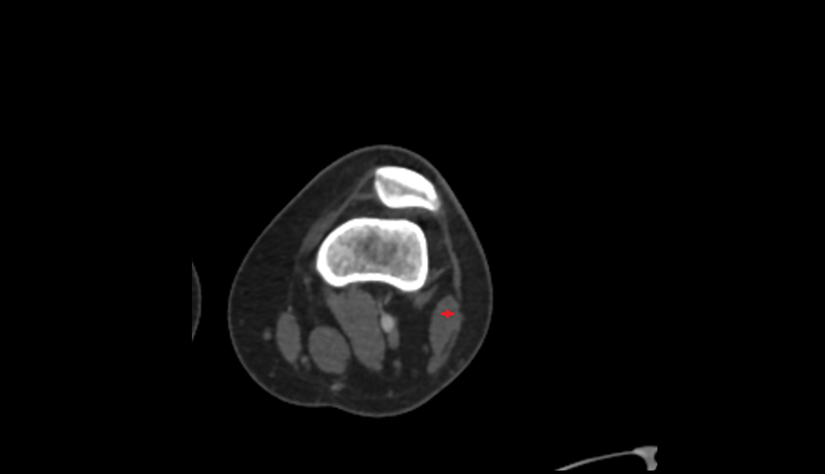 Biceps Femoris Muscle (Short Head) ct axial image 3
