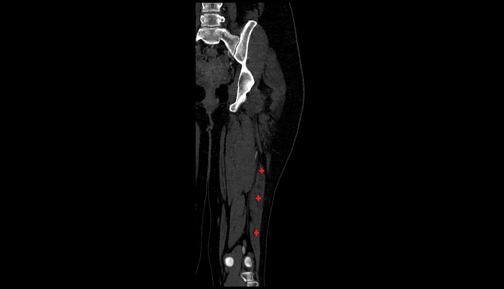 Biceps Femoris Muscle (short Head) ct coronal image