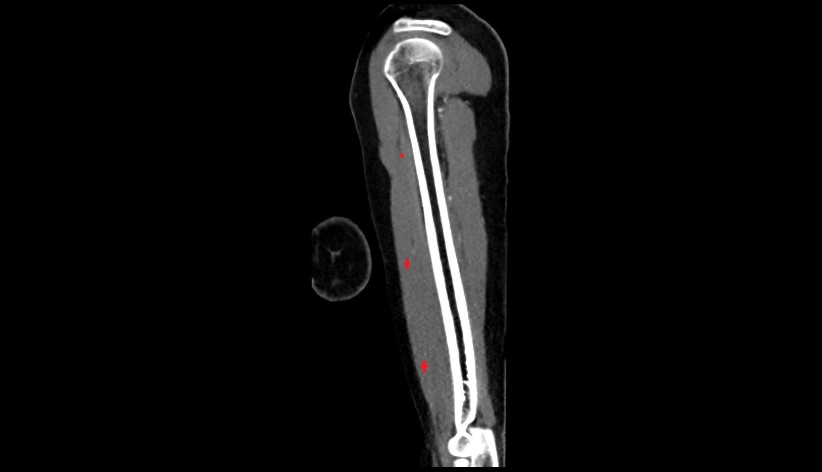 Biceps brachii muscle CT sag image