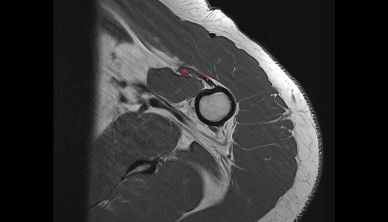 Biceps brachii muscle  axial cross sectional anatomy 3T MRI AI enhanced radiology image-img-00000-00000