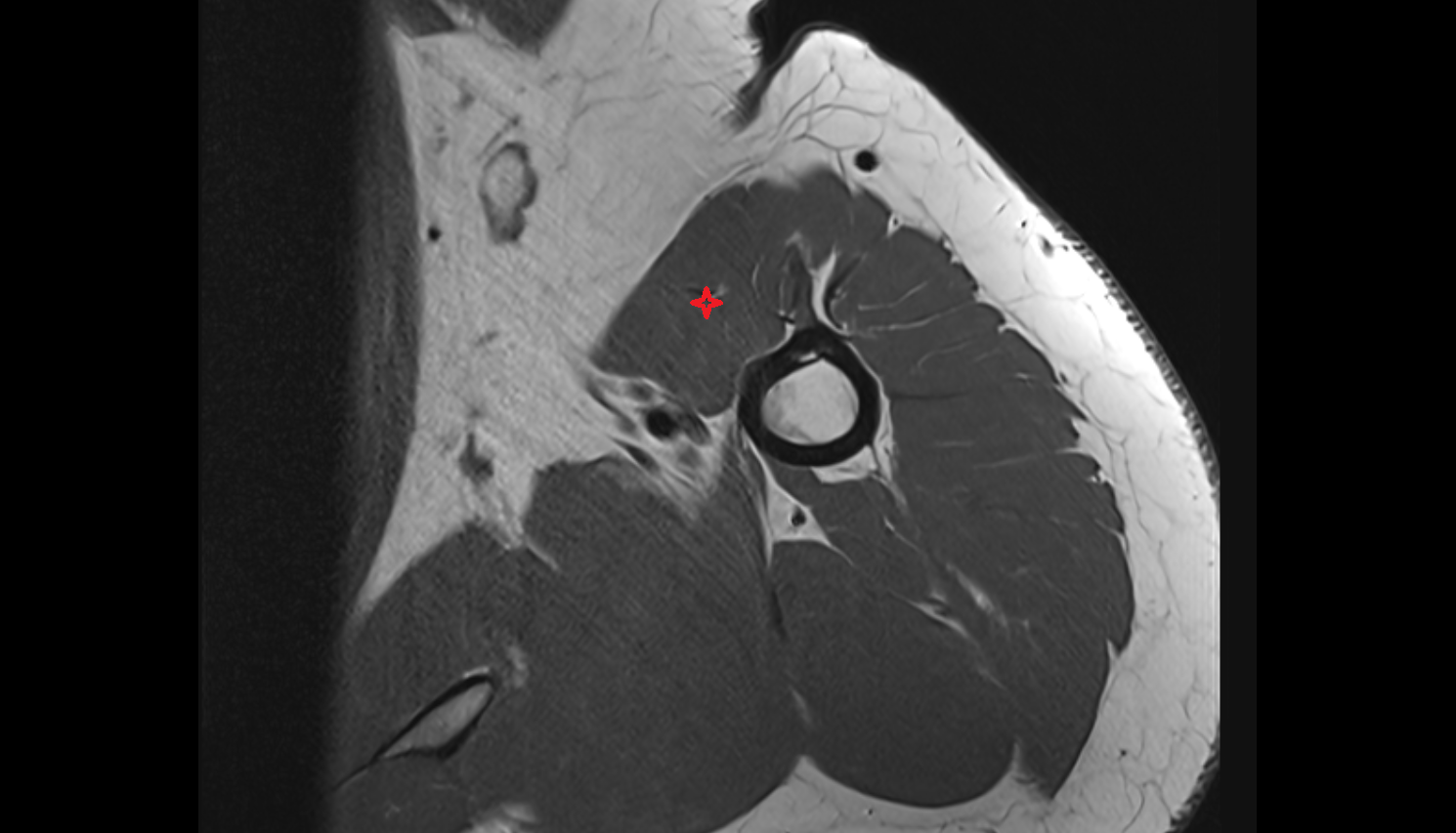 Biceps brachii muscle  axial cross sectional anatomy 3T MRI AI enhanced radiology image-img-00000-00000_00001