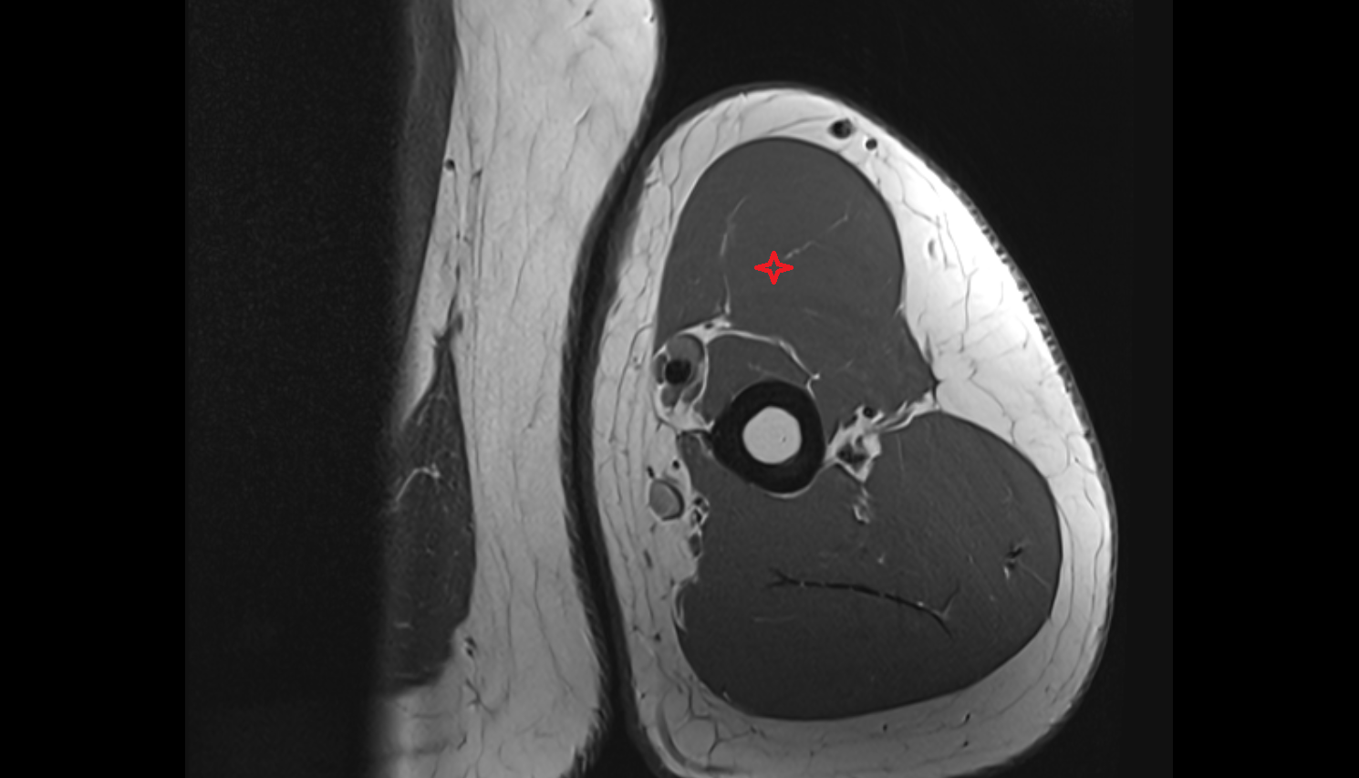 Biceps brachii muscle  axial cross sectional anatomy 3T MRI AI enhanced radiology image-img-00000-00000_00002