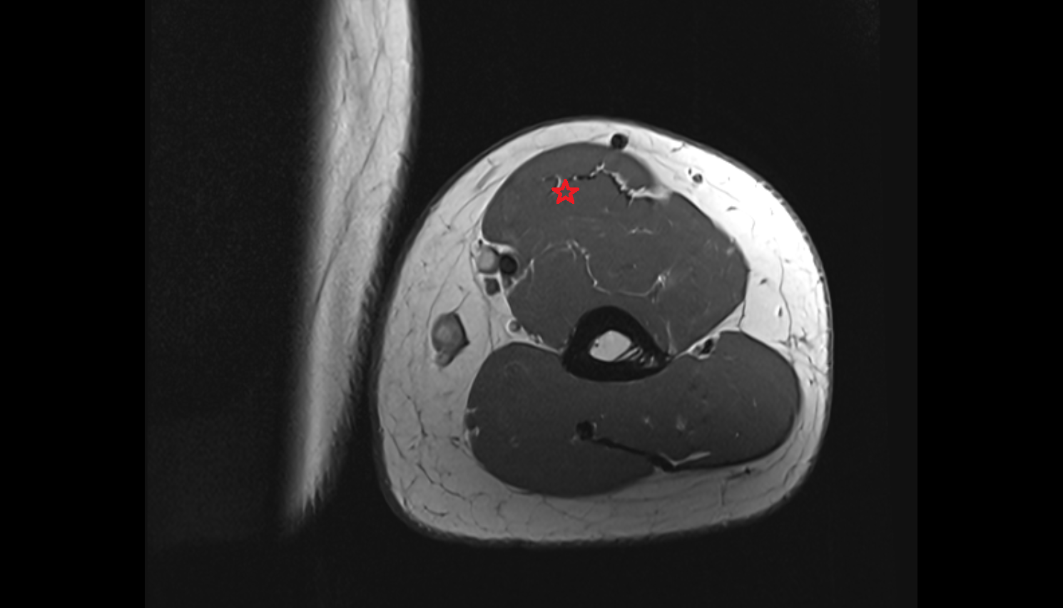 Biceps brachii muscle  axial cross sectional anatomy 3T MRI AI enhanced radiology image-img-00000-00000_00003