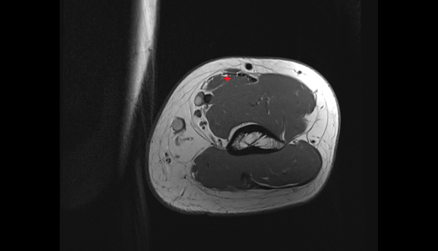 Biceps brachii muscle  axial cross sectional anatomy 3T MRI AI enhanced radiology image-img-00000-00000_00005