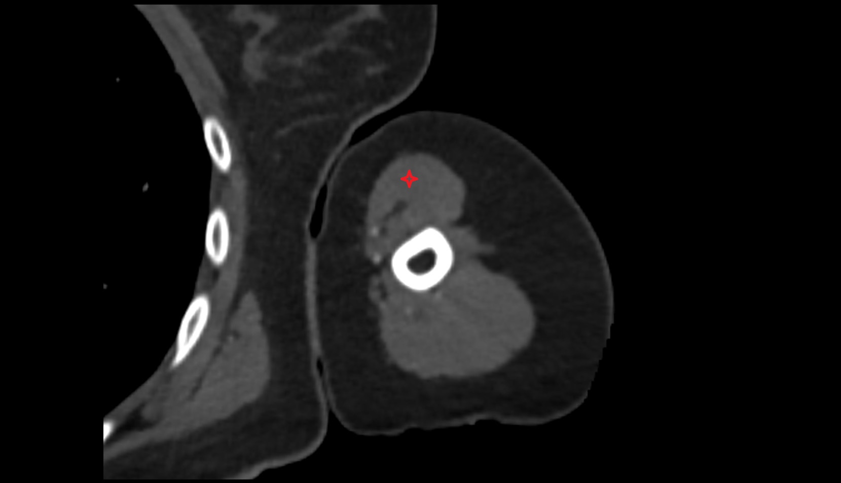 Biceps brachii muscle ct