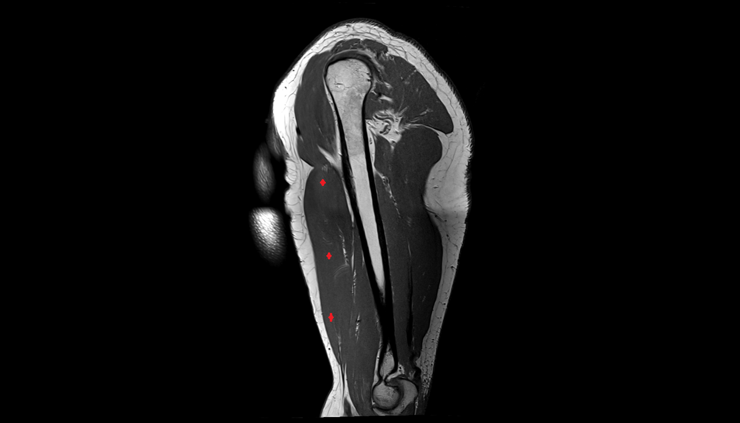 Biceps brachii muscle sag cross sectional anatomy 3T MRI AI enhanced radiology image-img-00000-00000