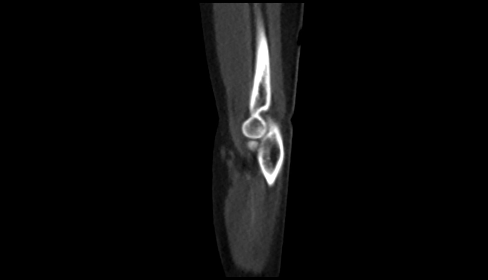 Biceps brachii tendon CT SAG image