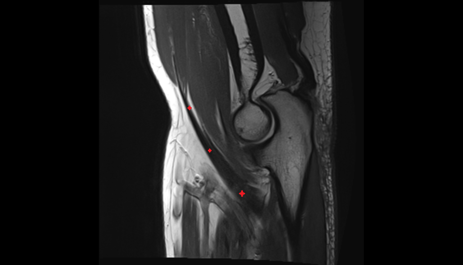 Biceps brachii tendon sag  cross sectional anatomy 3T MRI AI enhanced radiology image -img-00000-00000