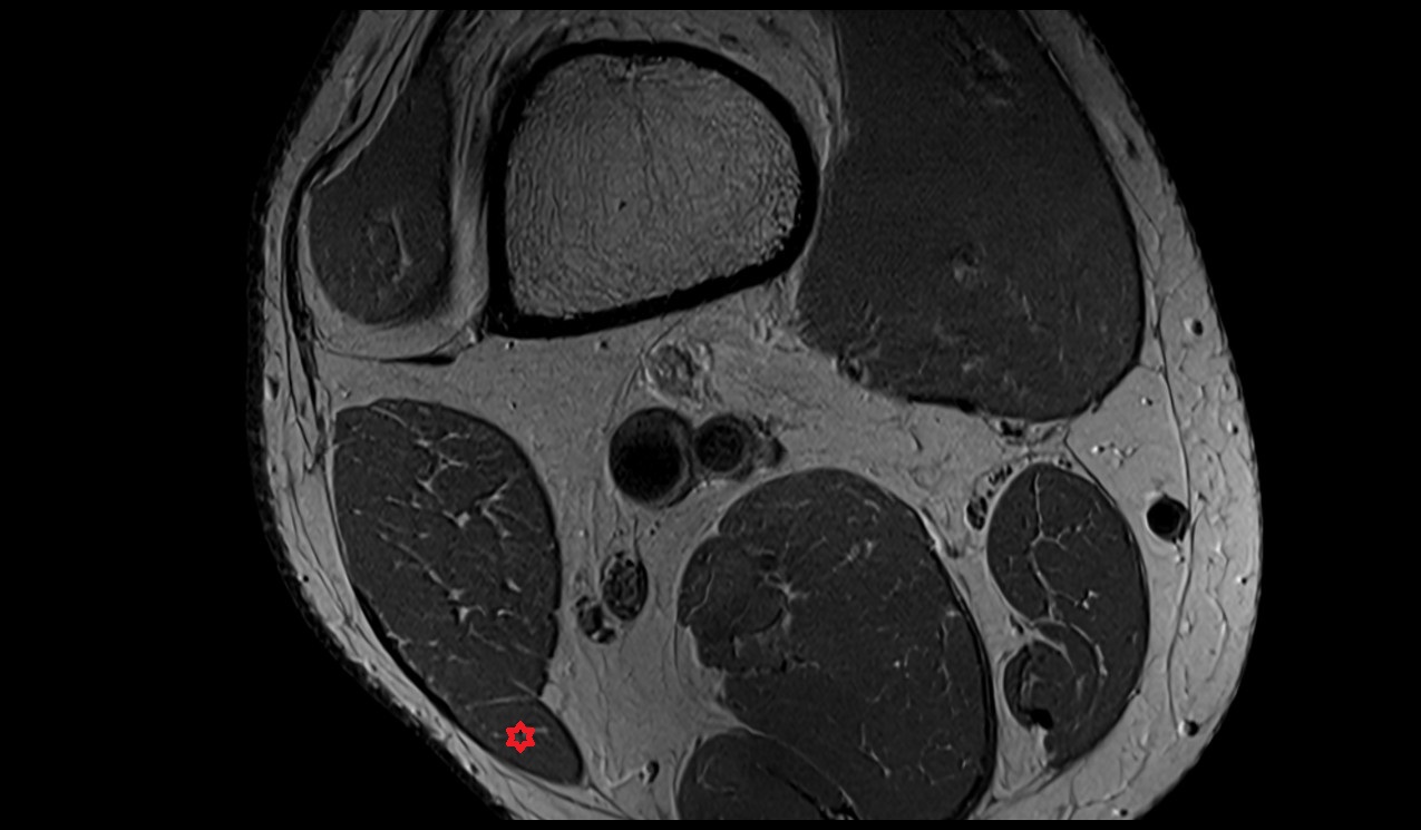Biceps femoris (Long head) image