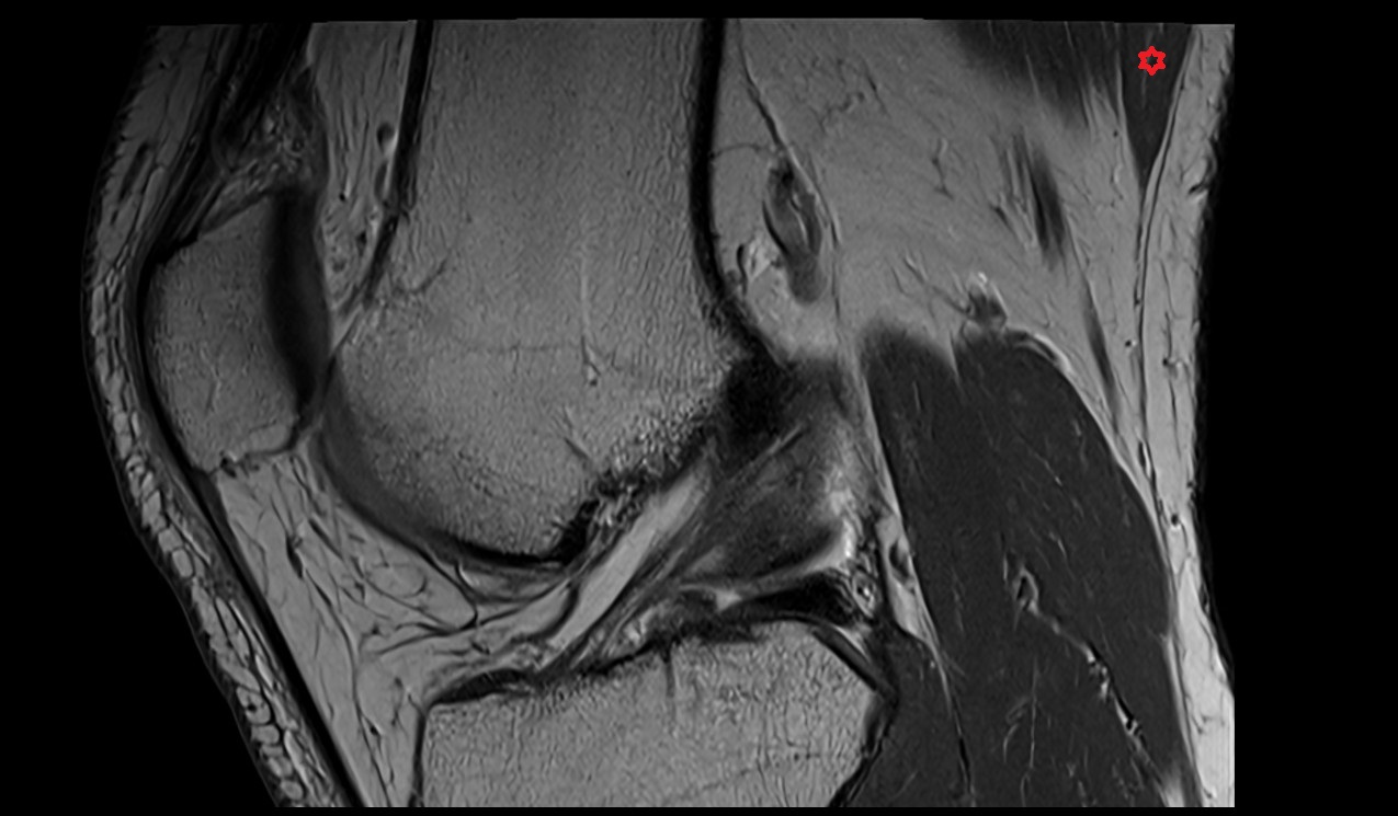 Biceps femoris (Long head) muscle mri image