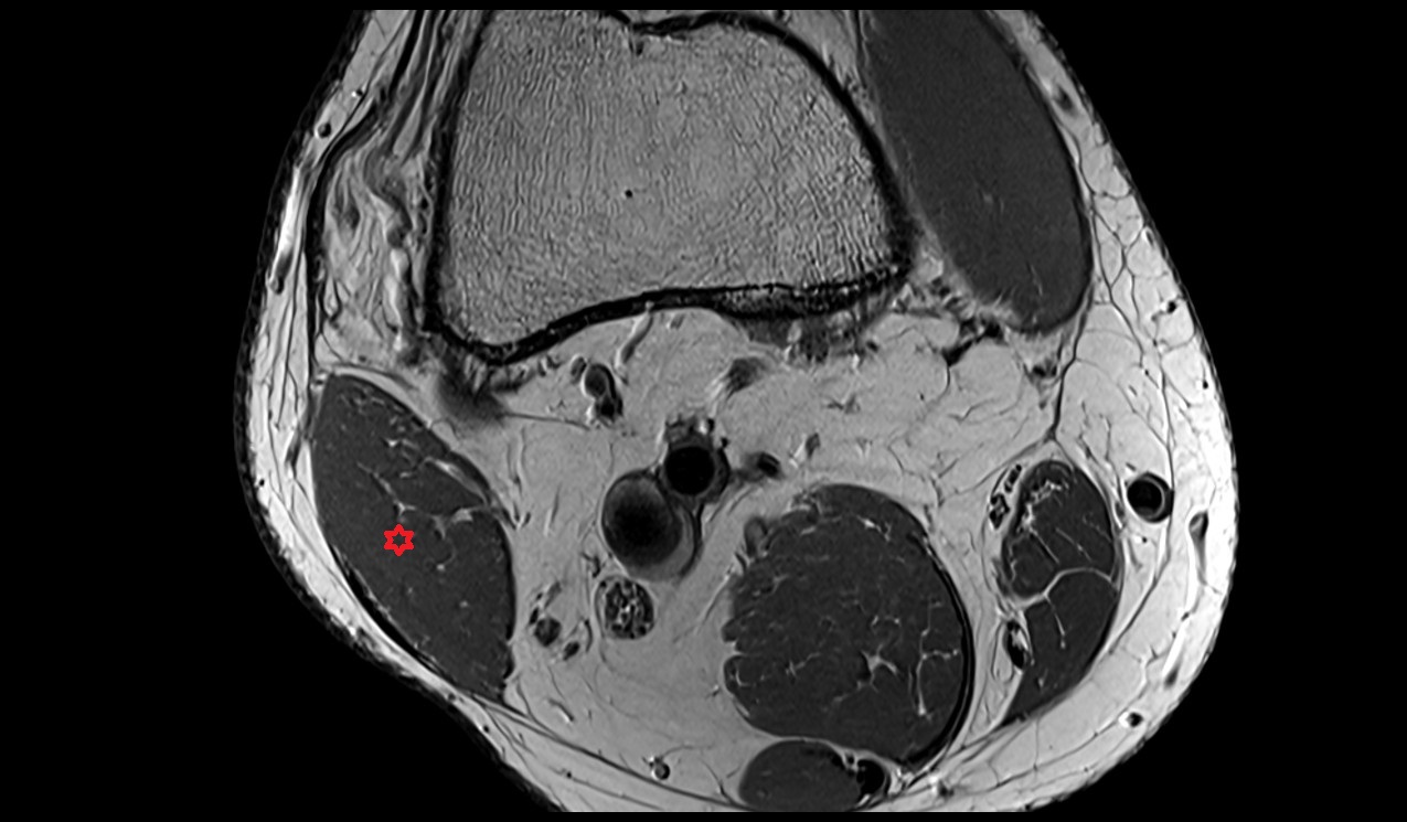 Biceps femoris (Short head) muscle