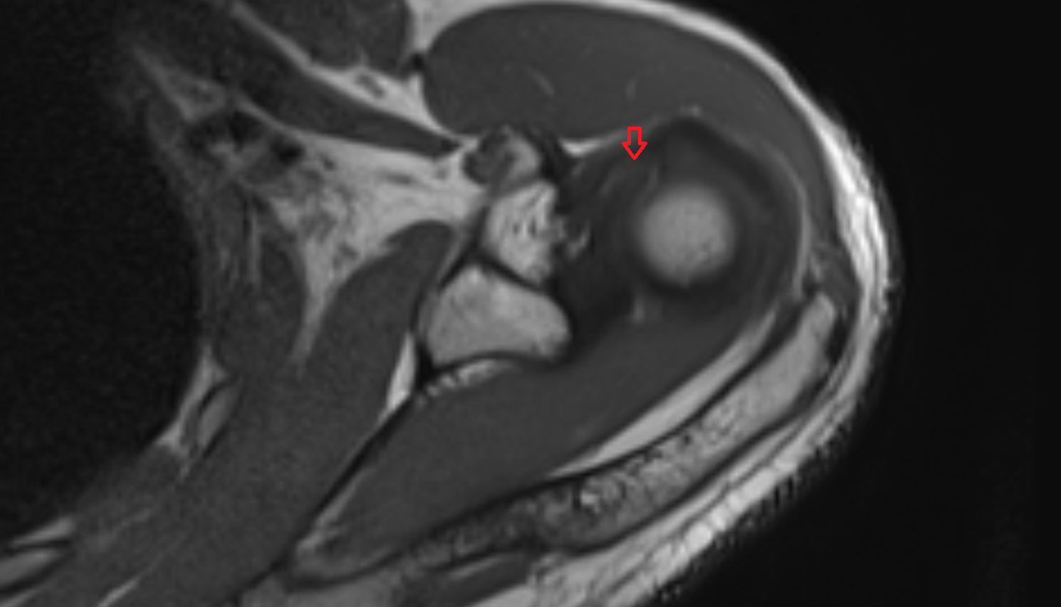 Biceps pulley ligments axial  cross sectional anatomy 3T MRI AI enhanced radiology image -img-00000-00000