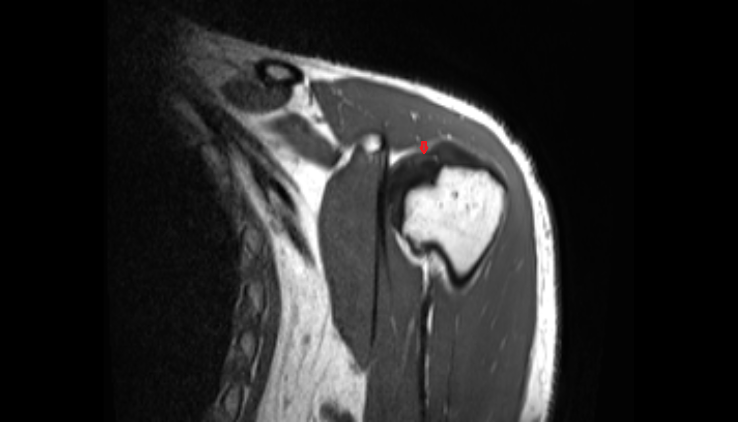Biceps pulley ligments coronal  cross sectional anatomy 3T MRI AI enhanced radiology image -img-00000-00000
