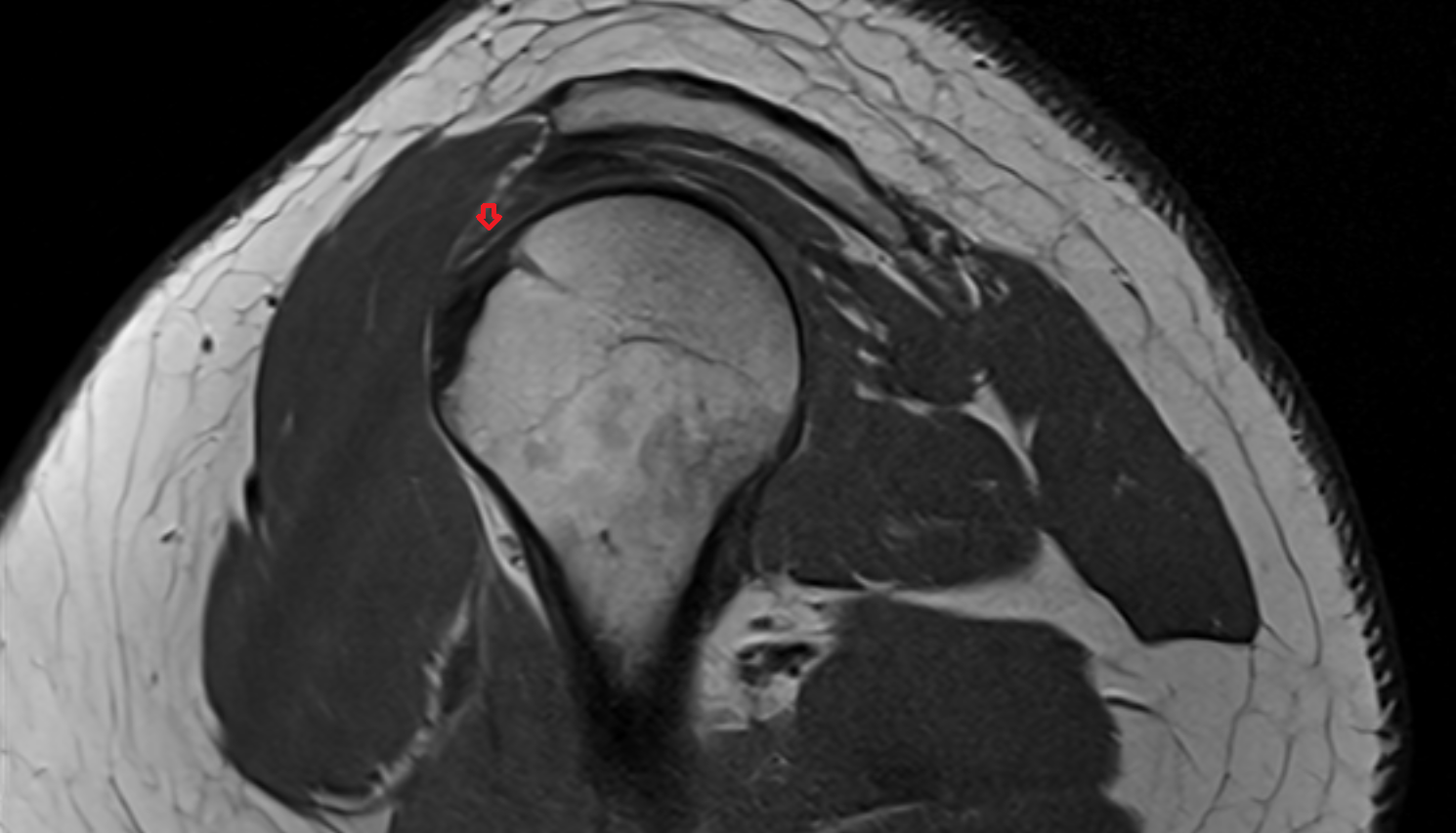 Biceps pulley ligments sagl  cross sectional anatomy 3T MRI AI enhanced radiology image -img-00000-00000