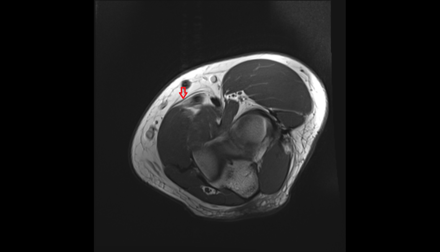 Bicipital aponeurosis axial cross sectional anatomy 3T MRI AI enhanced radiology image -img-00000-00000