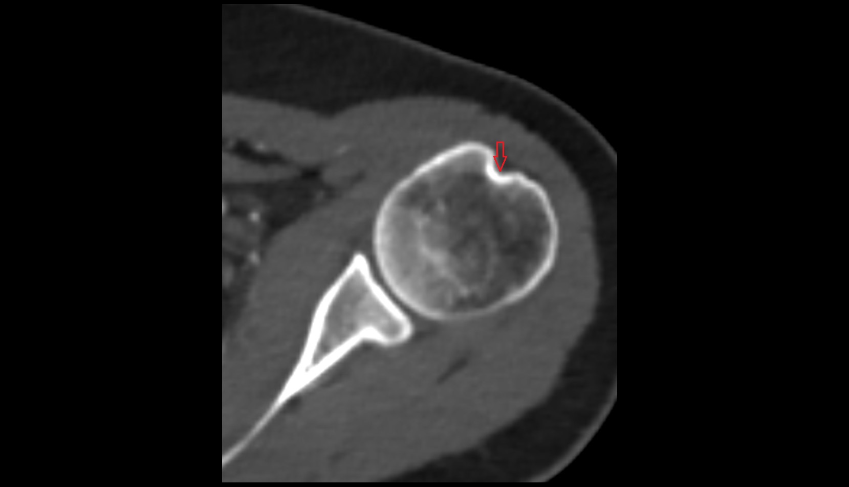 Bicipital groove CT AXIAL image
