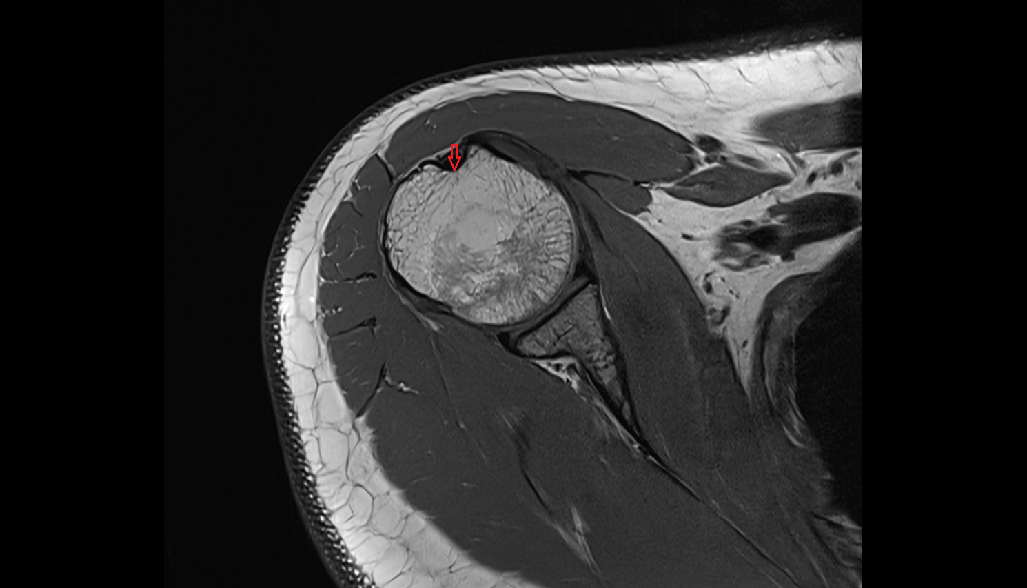 Bicipital groove  axial cross sectional anatomy 3T MRI AI enhanced radiology image-img-00000-00000