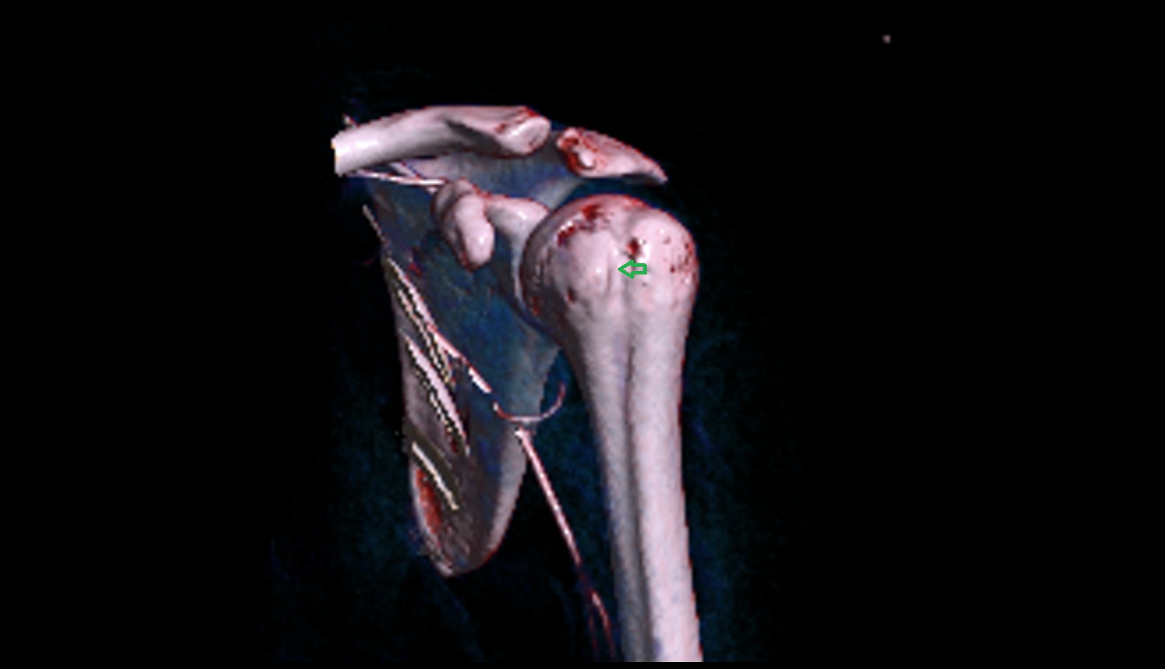 Bicipital groove ct 3d image