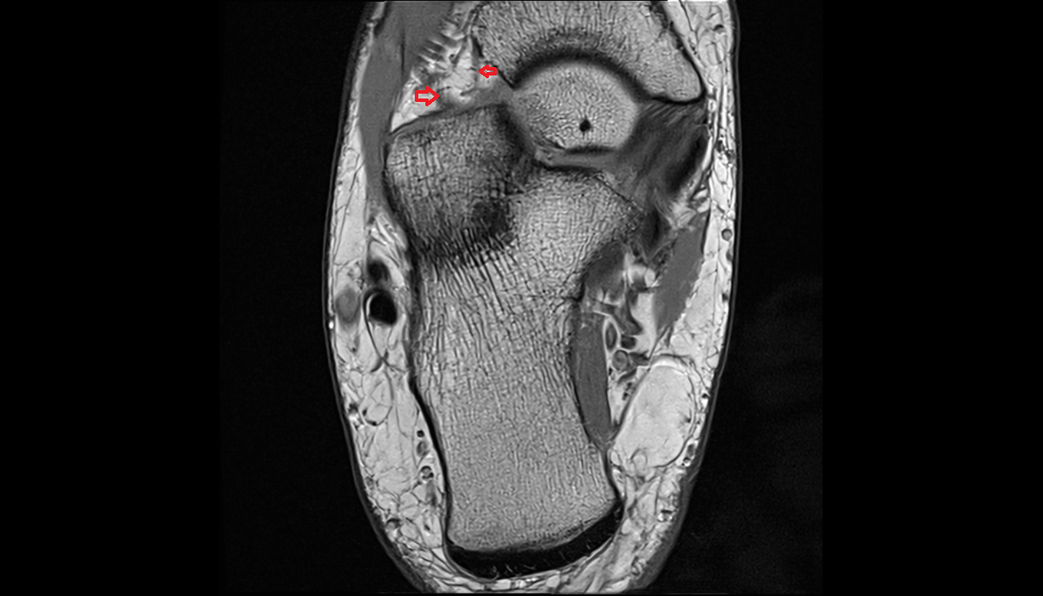 Bifurcate ligament axial cross sectional anatomy 3T MRI AI enhanced radiology image-img-00000-00000