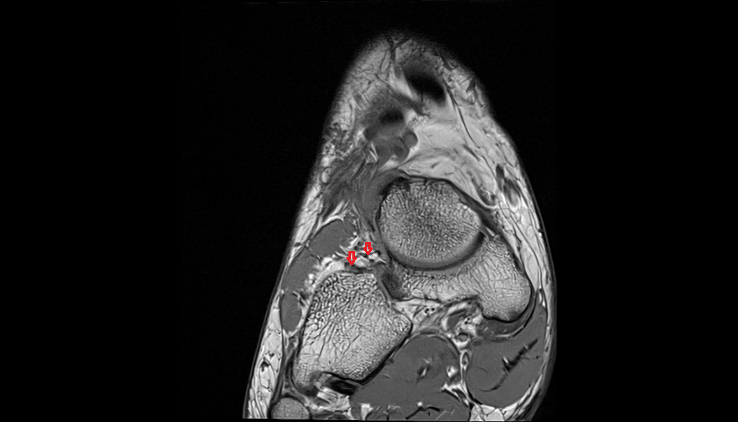 Bifurcate ligament coronal cross sectional anatomy 3T MRI AI enhanced radiology image-img-00000-00000