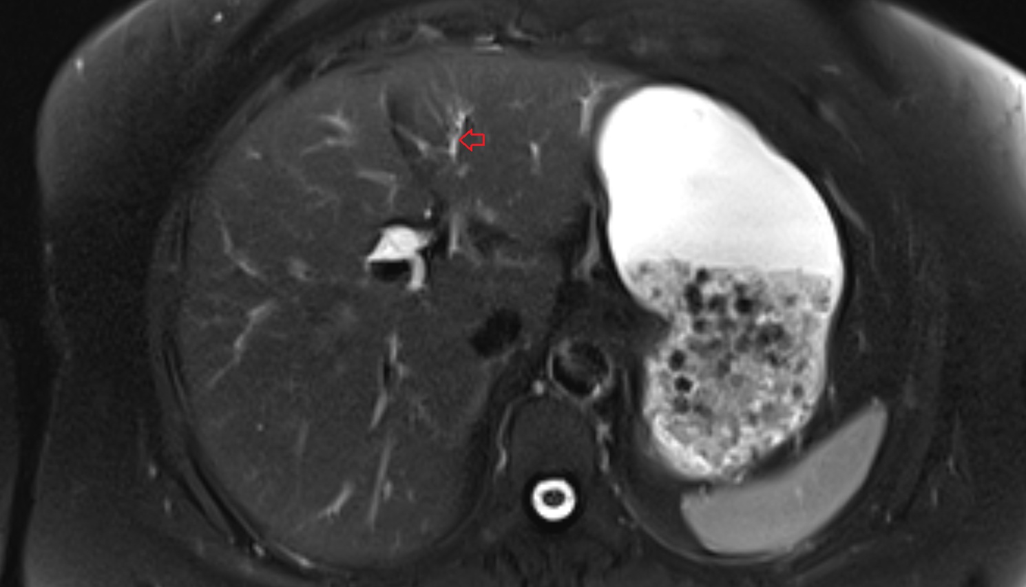 Bile duct serving liver segment III  MRI axial  anatomy image-img-00000-00000