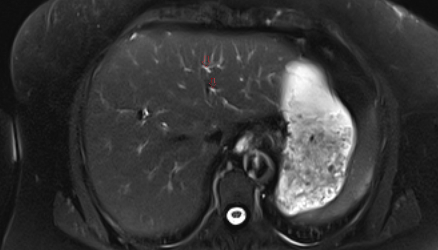 Bile duct serving liver segment II  MRI axial  anatomy image-img-00000-00000
