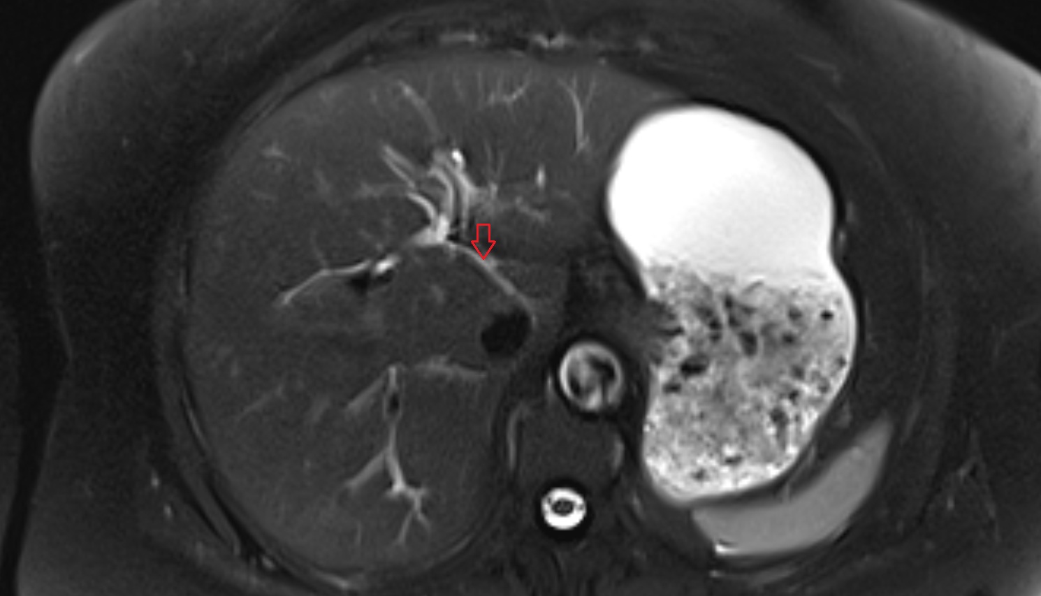 Bile duct serving liver segment I  MRI axial  anatomy image-img-00000-00000