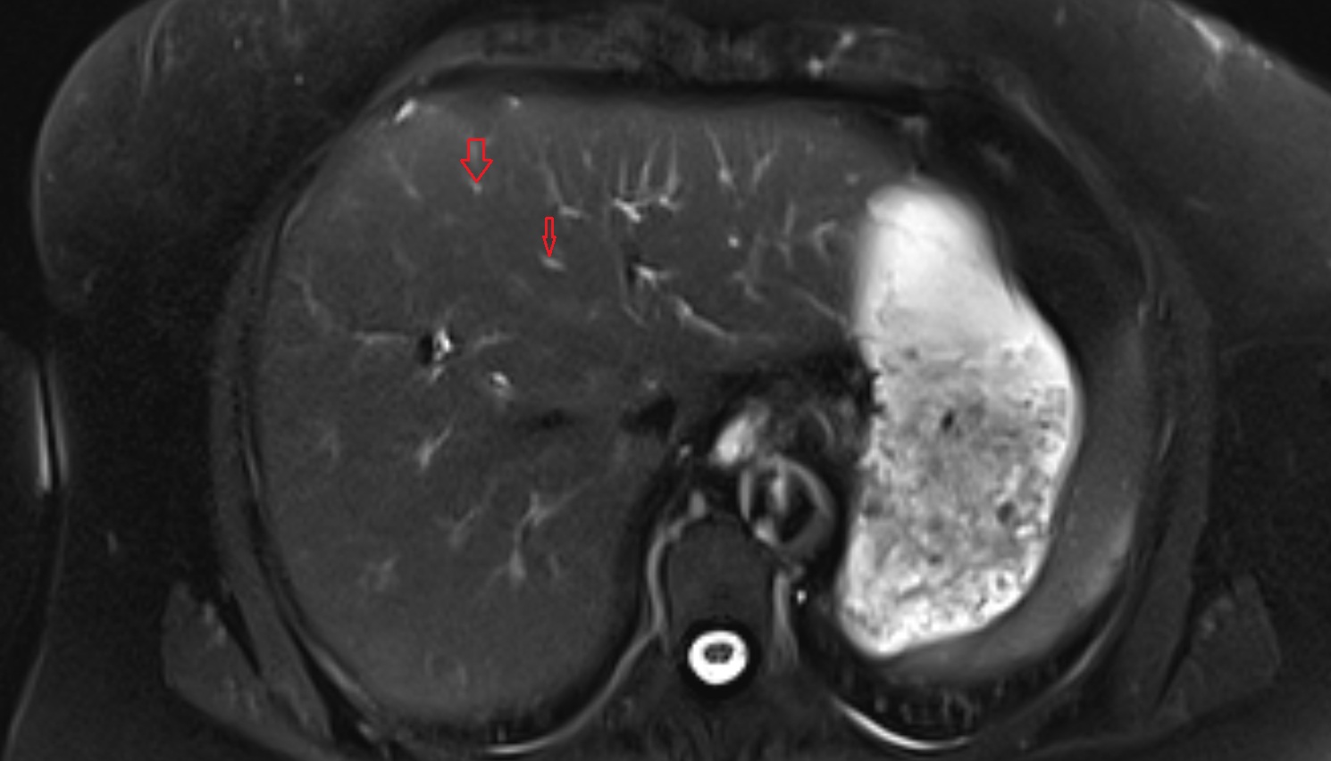 Bile duct serving liver segment IVa  MRI axial  anatomy image-img-00000-00000